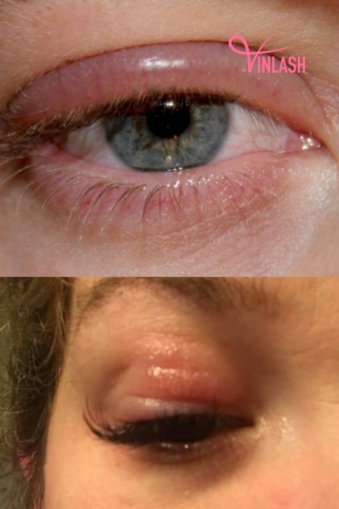 Cause of Eyelash Infections