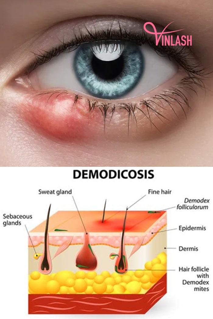 Signs of Infection In Eyelash Extension