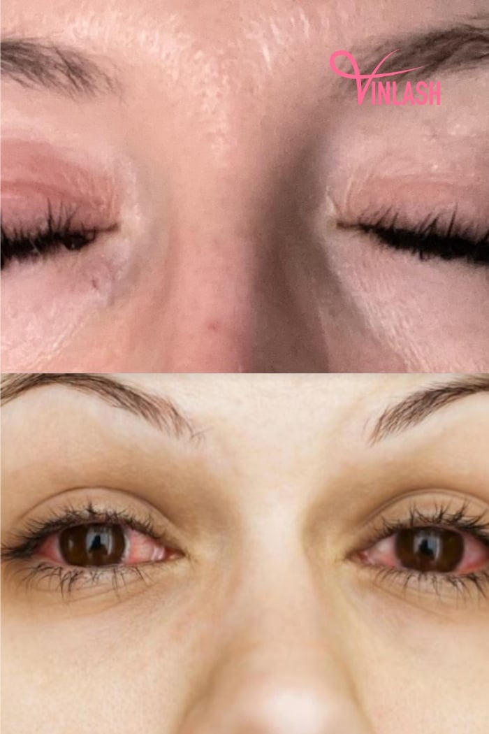 Symptoms of eyelash extensions itchy