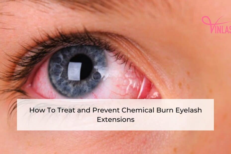 how-to-treat-and-prevent-chemical-burn-eyelash-extensions