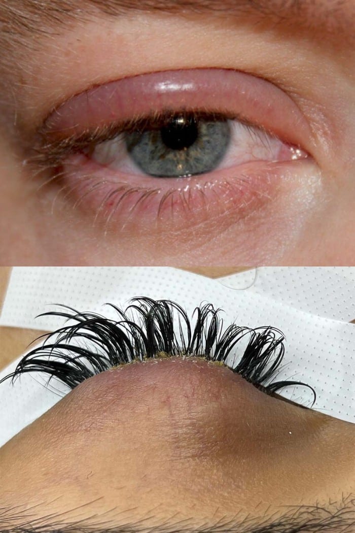 What Is Blepharitis Eyelash Extensions?