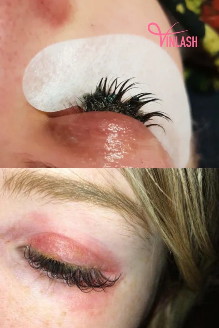 Chemical Burn vs Allergic Reaction