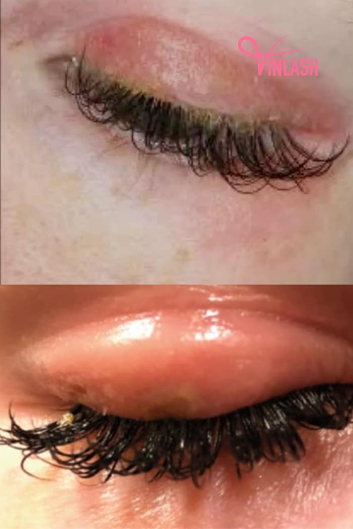 What is an Eyelash Infection