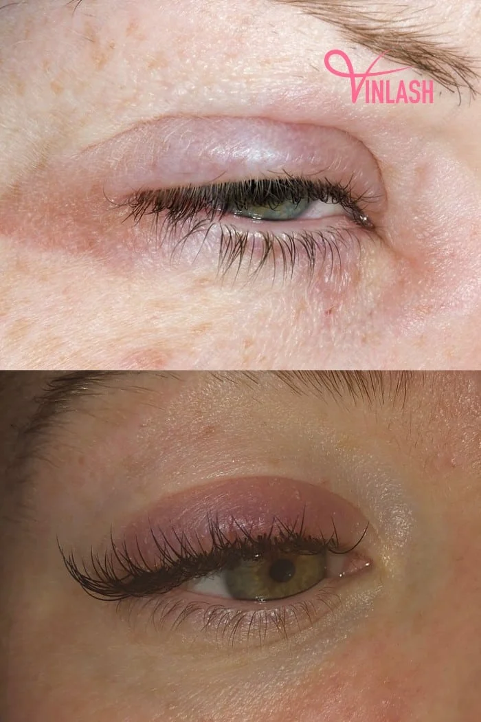 Allergic Reaction Symptoms in the Eyelids