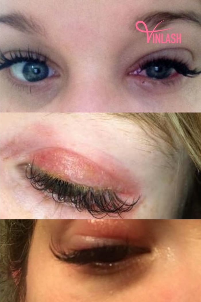 Solutions to Eyelash Infections