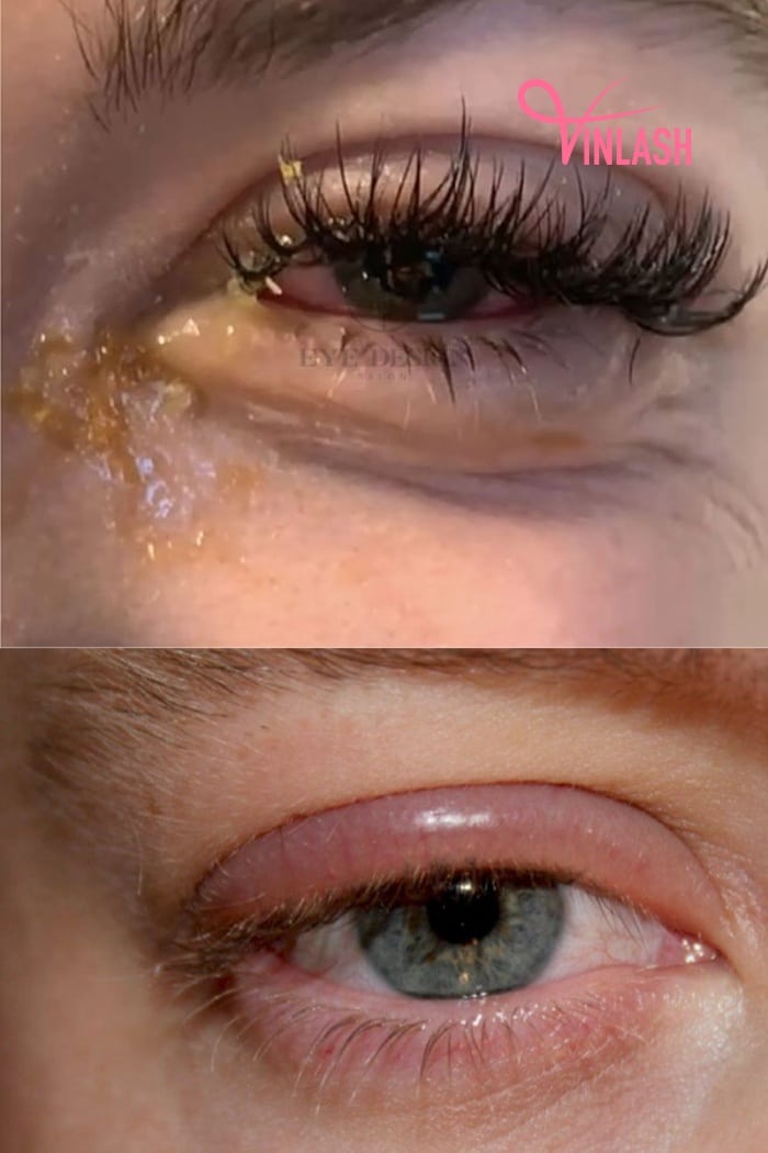 An Overview of Infections from Eyelash Extensions